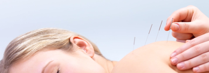Acupuncture needles being inserted into a patient’s shoulder.