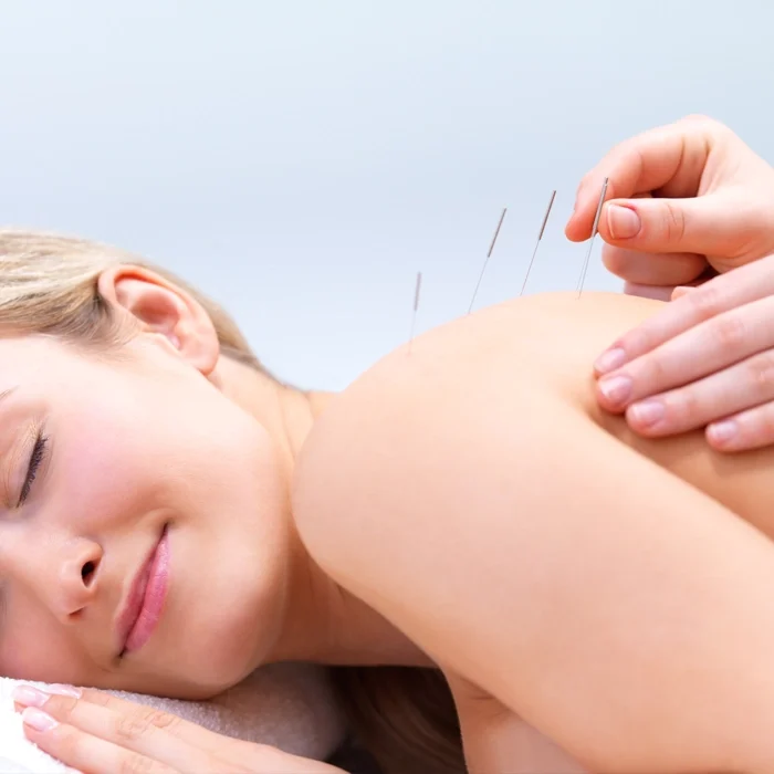 A woman receiving acupuncture needles in her shoulder.