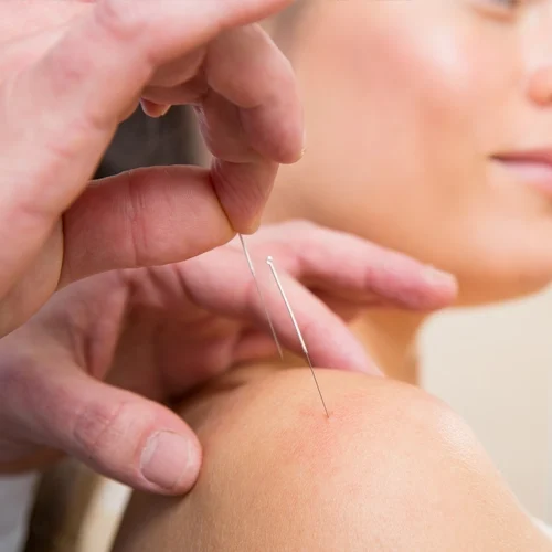 A woman receiving shoulder acupuncture treatment.